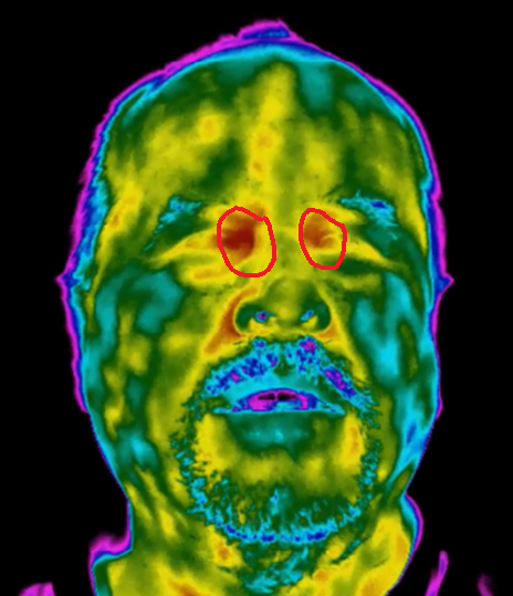 Thermal image of tear duct